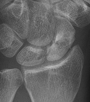 Scaphoid Nonunion Sclerotic Margin